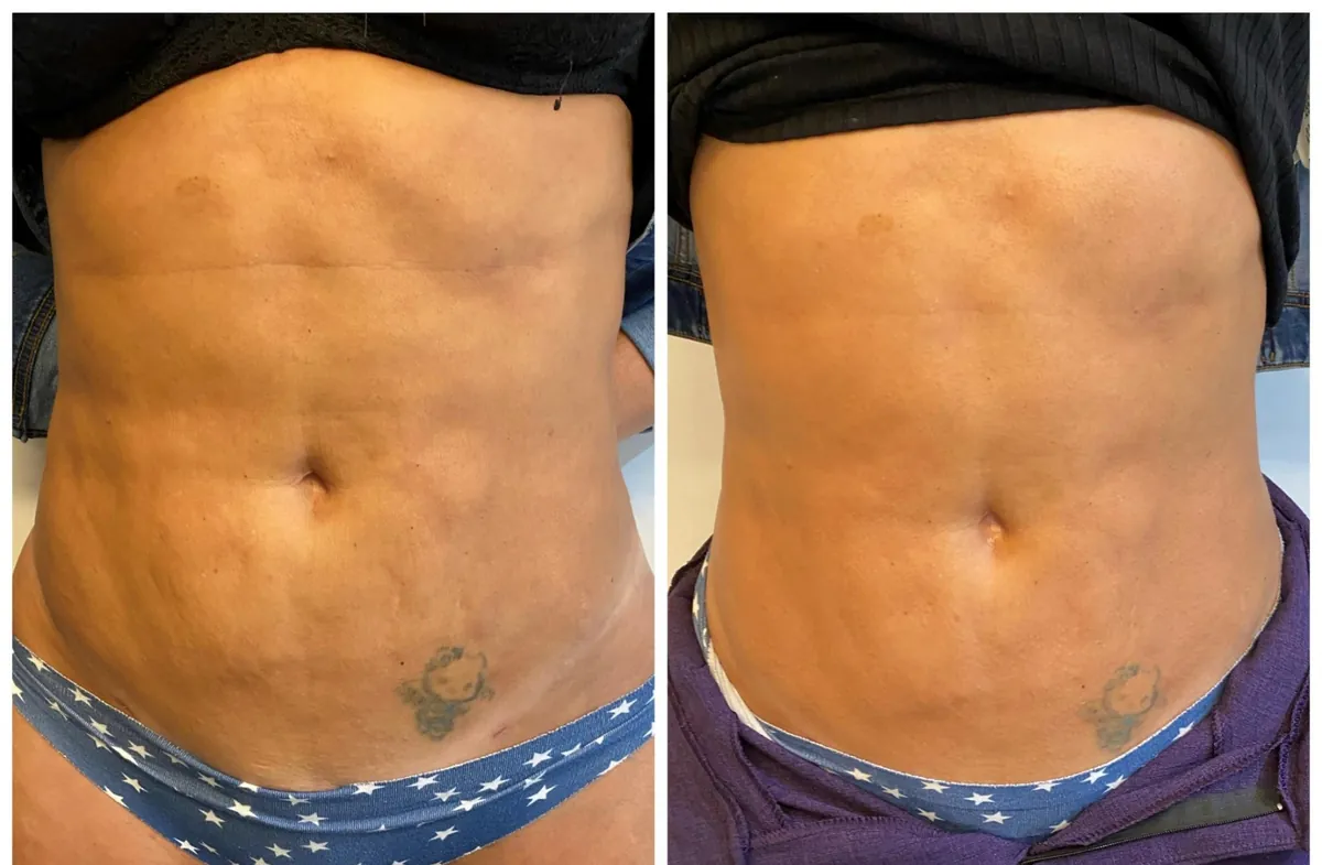 Abdomen con fibrosis post-liposucción: antes (izquierda) e inmediatamente después de 1 sesión (derecha)