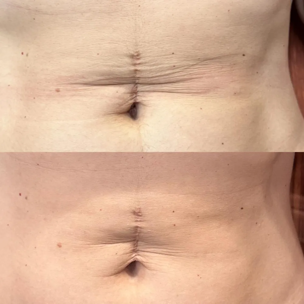 Flacidez cutánea en abdomen: antes (arriba) y después de 3 sesiones (abajo)