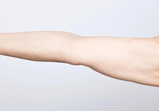 Brazo, después de 3 sesiones