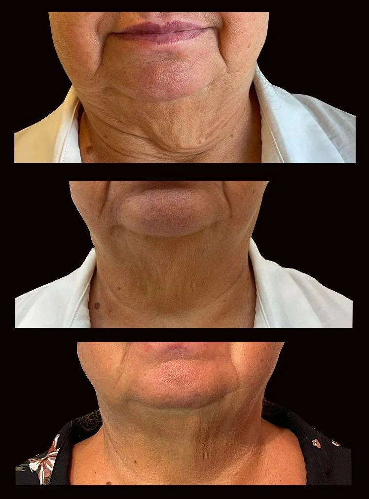Cuello: antes, después de 1 sesión y después de 2 sesiones (de arriba hacia abajo)