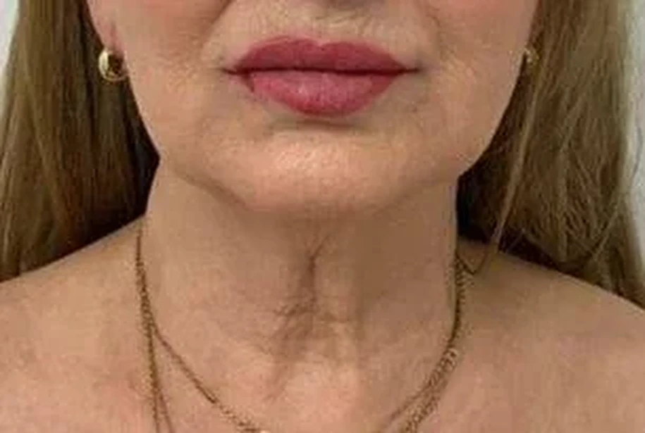 Cuello, antes