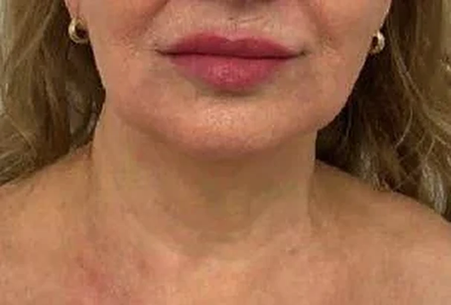 Cuello, después de 3 sesiones