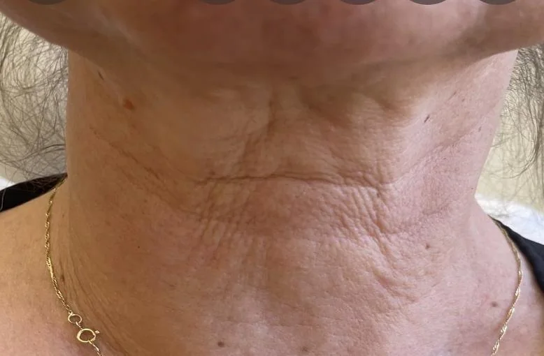 Cuello, antes