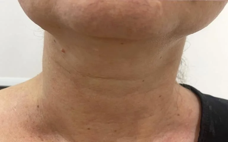 Cuello, después de 6 sesiones
