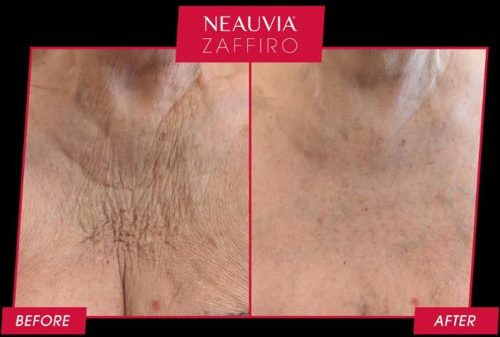 Cuello y escote antes y después de 1 sesión, composición original con etiquetas Before / After