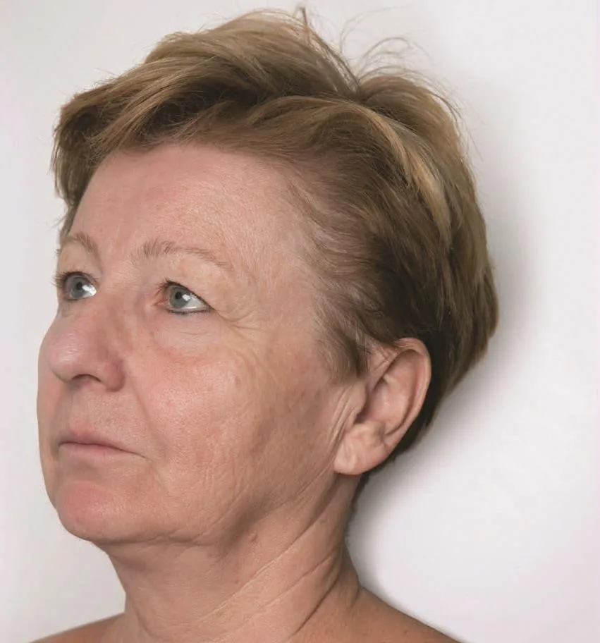 Rostro antes del tratamiento con ZAFFIRO