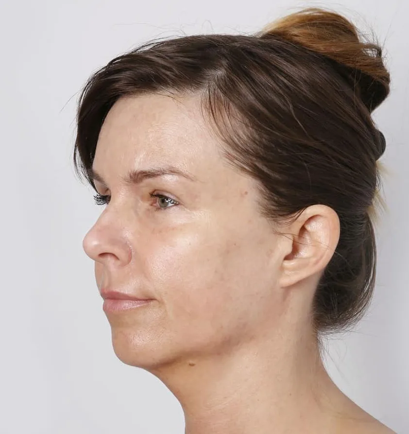 Rostro, después de 1 sesión