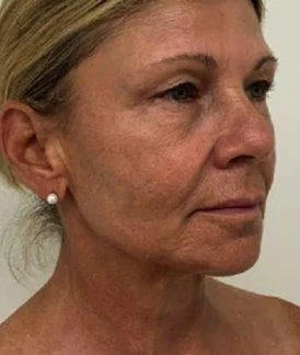Rostro, después de 2 sesiones